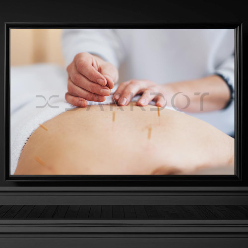 4570 akupunktur geleneksel masaj tedavisi yaptiran kadin gobek gobege igne ile tedavi